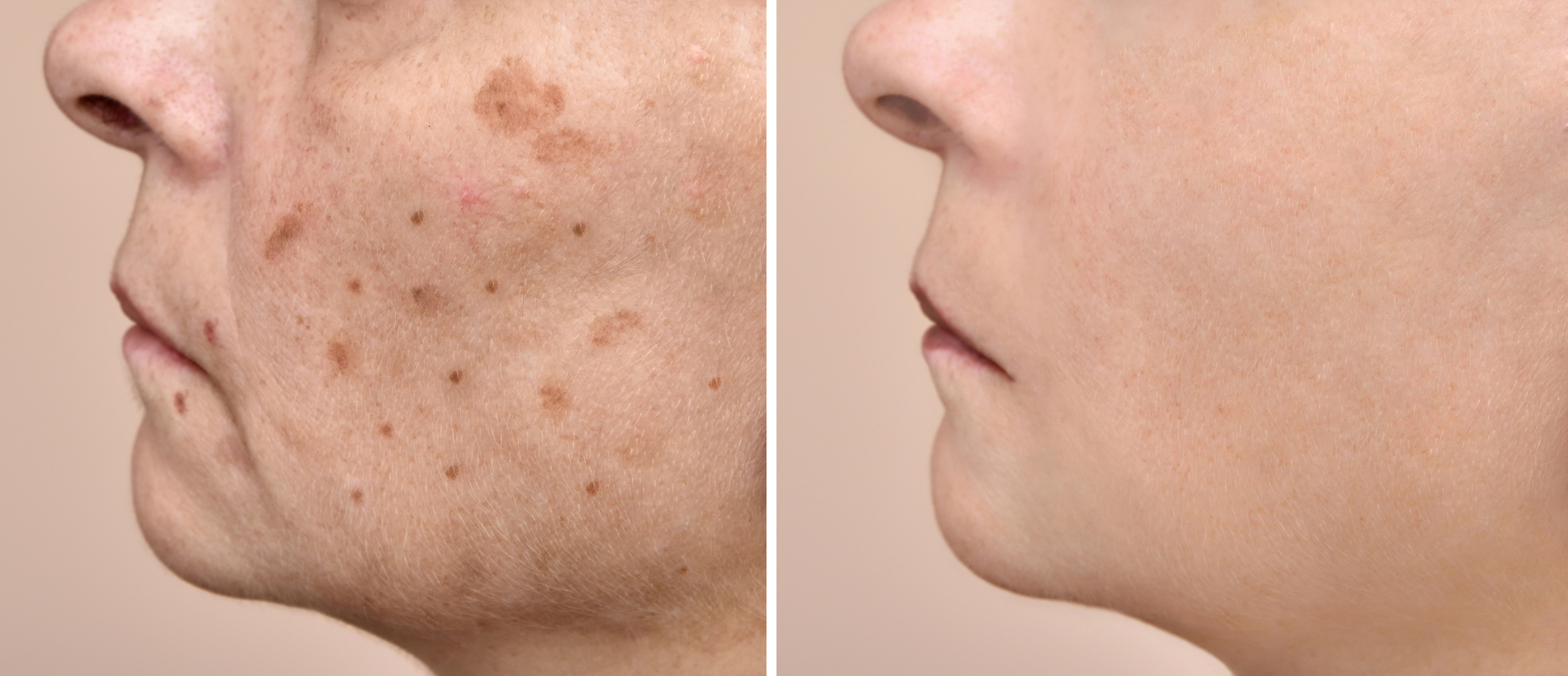 Before and after IPL treatment showing dramatic reduction in age spots and pigmentation on face